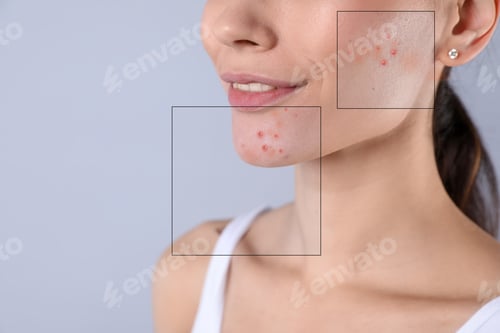 Preview: Woman before and after acne treatment, closeup. Collage showing difference on light grey background