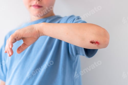 Preview: Child experiencing pain from a scraped elbow, showing an abrasion and mild bleeding, requiring first