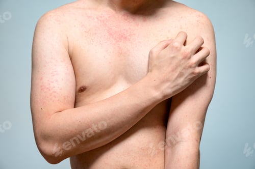 Preview: Dermatitis rash viral disease with immunodeficiency on body of young adult asian, scratching with it