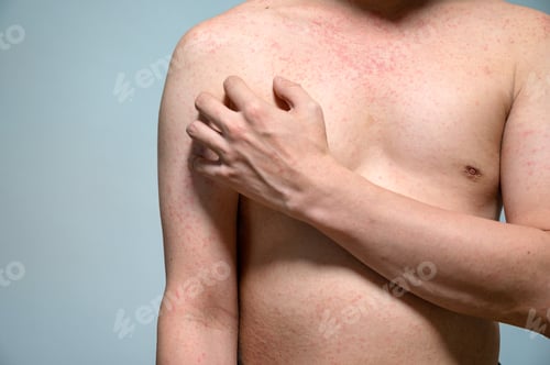 Preview: Dermatitis rash viral disease with immunodeficiency on body of young adult asian, scratching with it