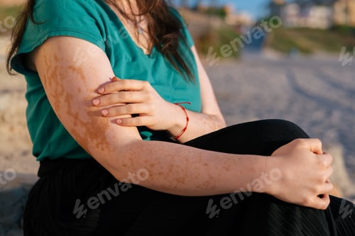 Preview: Woman with vitiligo embracing her changing skin