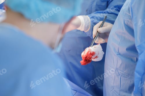 Preview: Surgeon Holding Tissue During Complex Hip Replacement Surgery